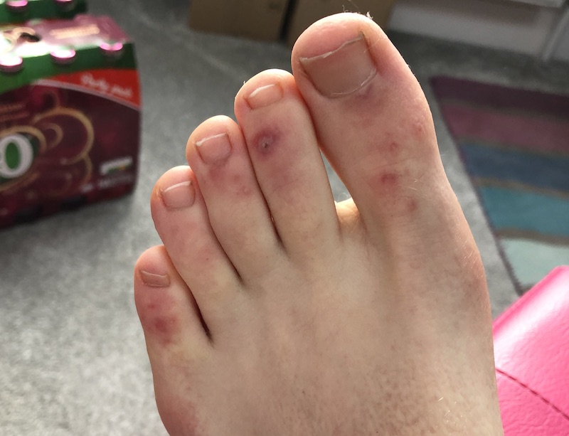 Raynaud's on feet can cause chilblains