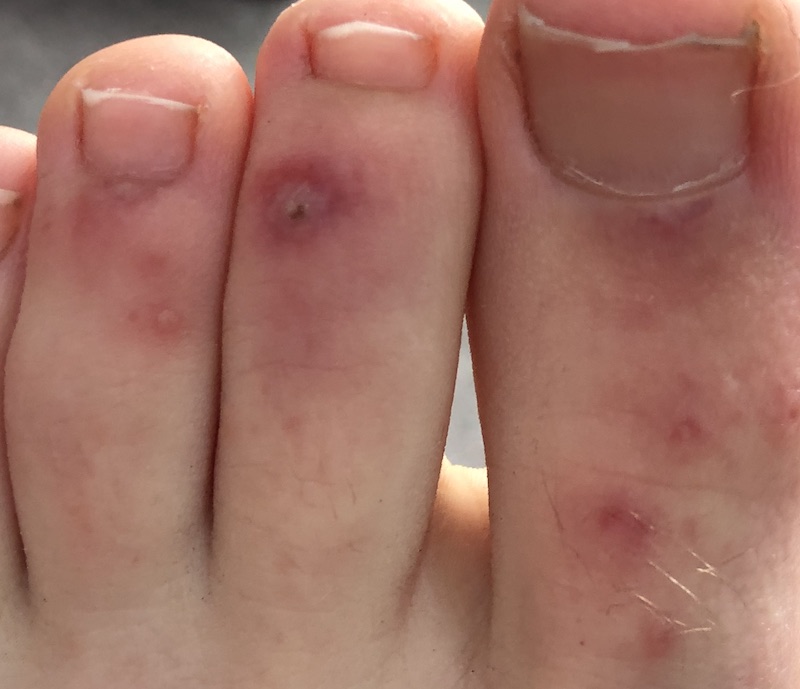 Infected chilblains from Raynaud's disease