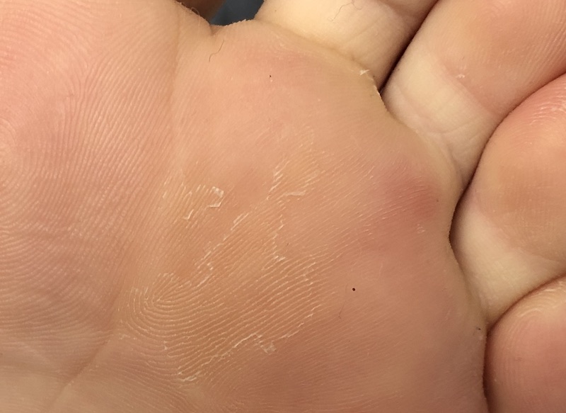 Raynaud's can cause flaky skin on the soles of the feet